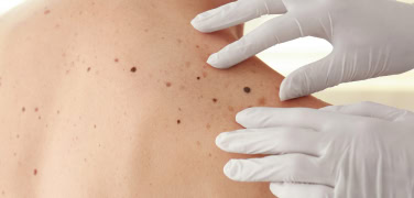 Moles and freckles on woman's back