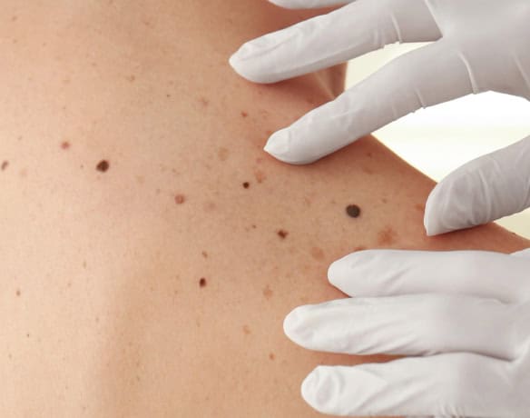 moles and freckles on a woman's back being examines by a female doctor in medical gloves