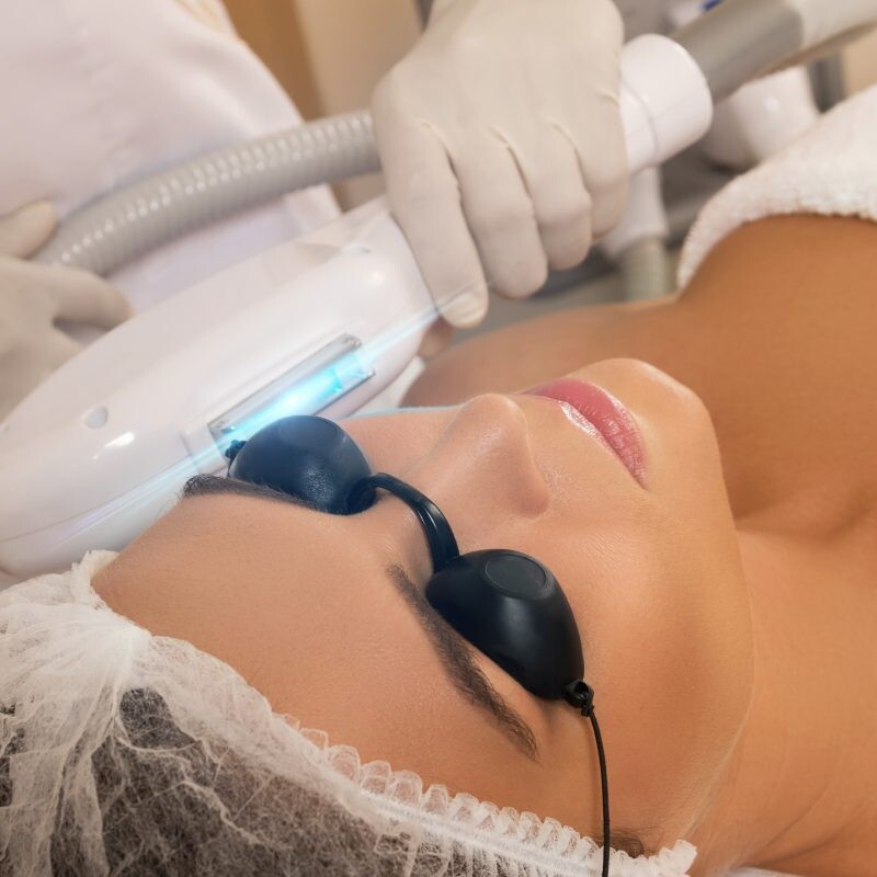 A woman with protective glasses on undergoes a skin rejuvenation process involving laser therapy