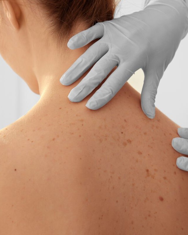 A medical professional examines moles and freckles on a woman's back