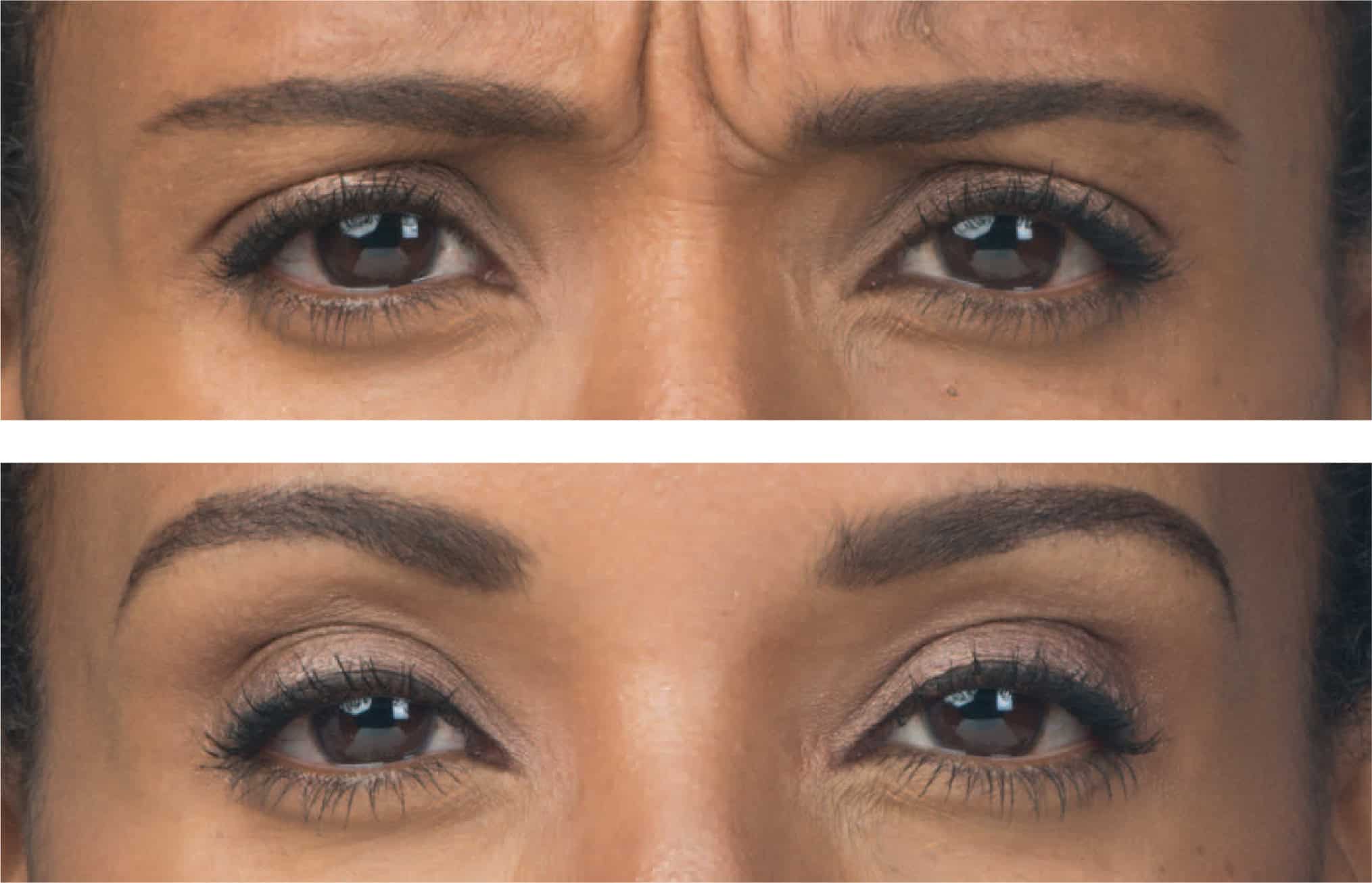 Two close-up images of a woman's face to show how botox relaxes wrinkles