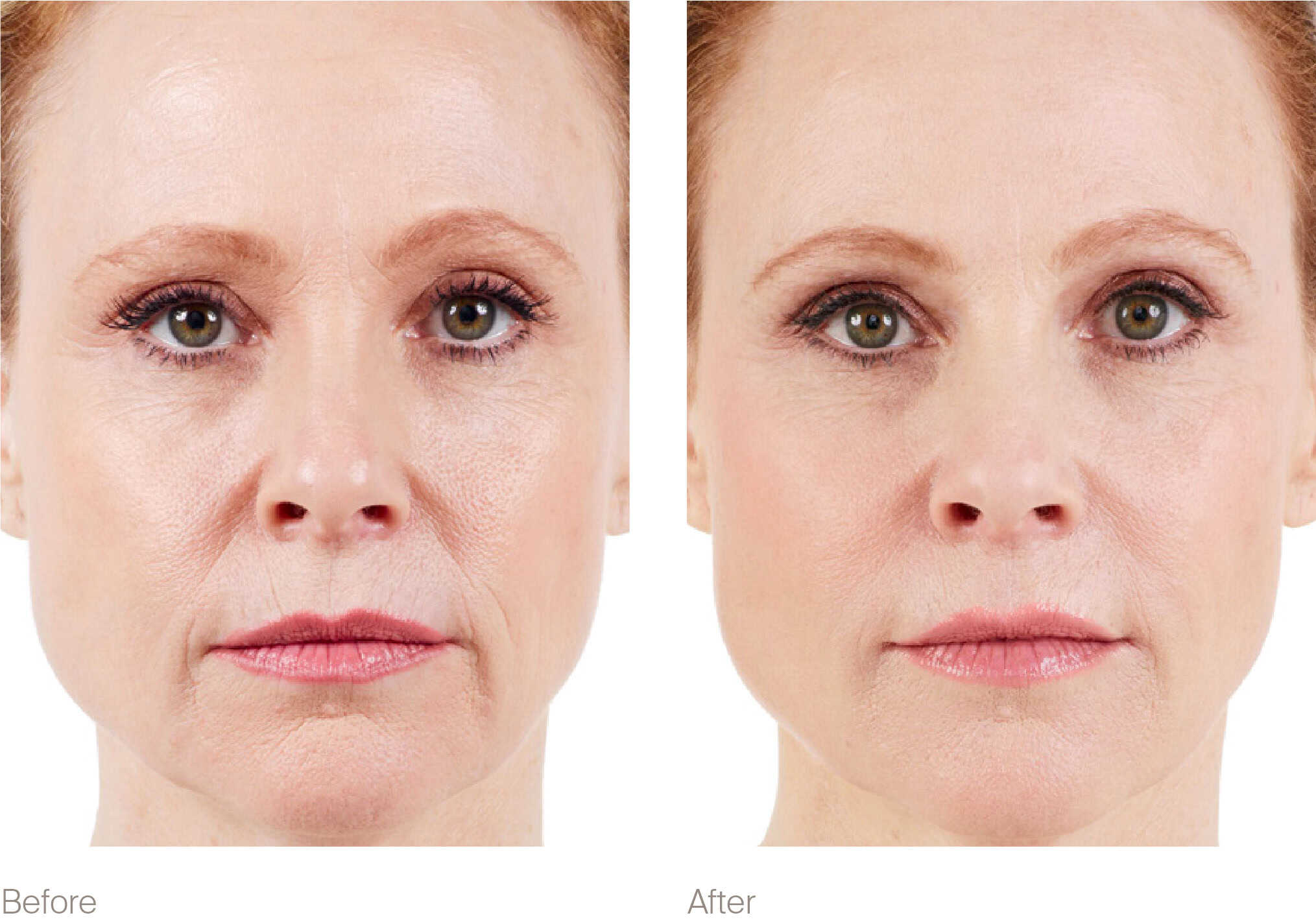 Before and after photos show improvements from a dermal filler application on a woman's face