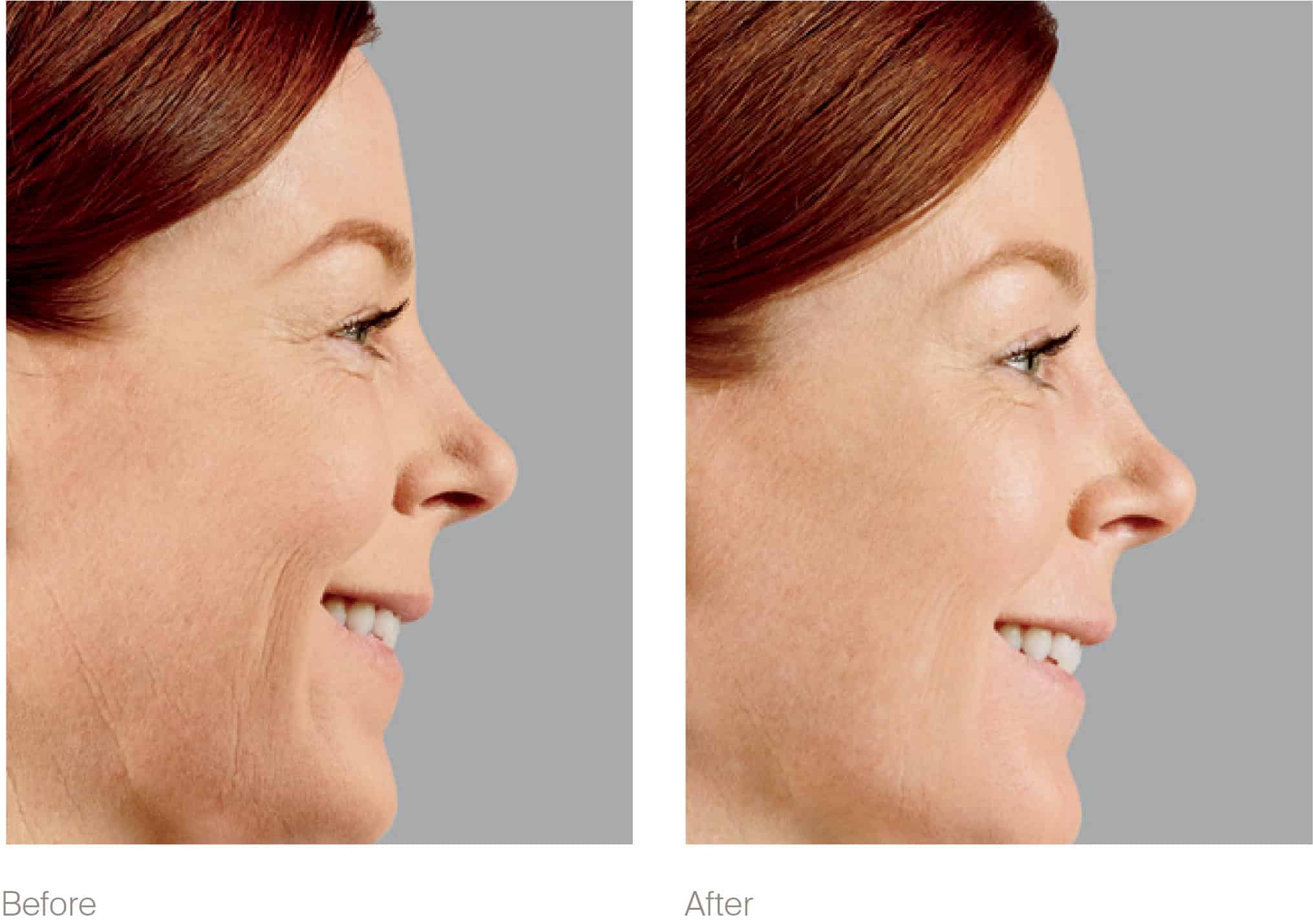 Before and after side-view photos of a woman's face show improvements from use of dermal fillers