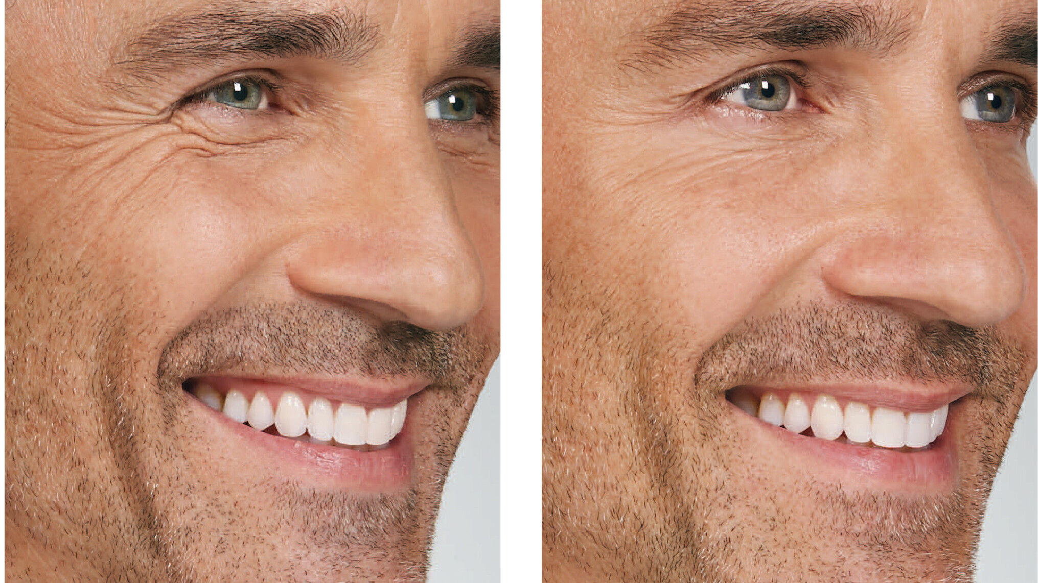 Before and after closeup photos of a man with stubble after getting facial treatment for crow's feet