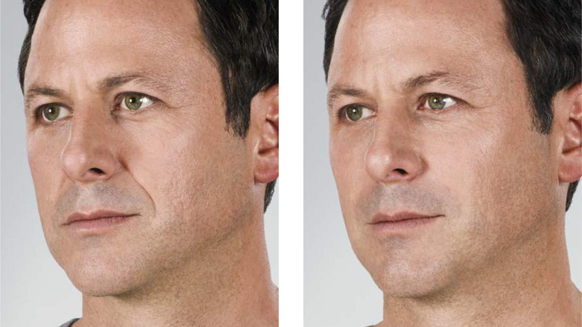 Before and after photos of a man's face after getting facial treatments at Surgical Dermatology Group