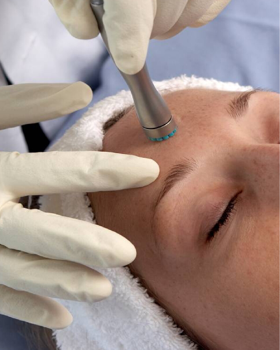 A provider uses a DermaSweep wand to gently remove the topmost layer of a patient's skin