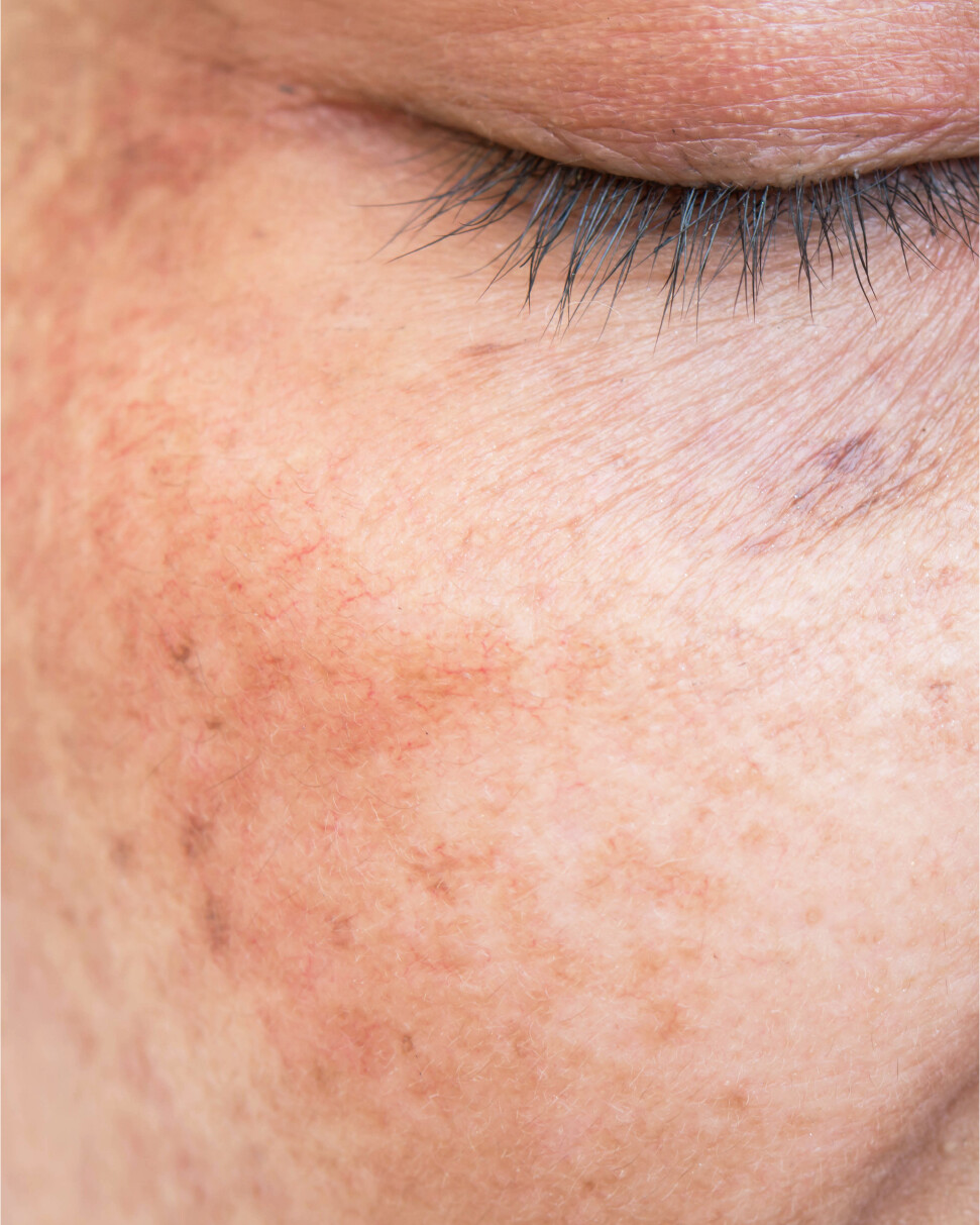 Woman's face showing signs of skin cancer