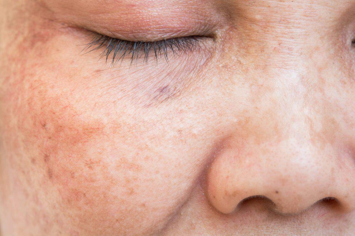 Sun damage on a woman's face