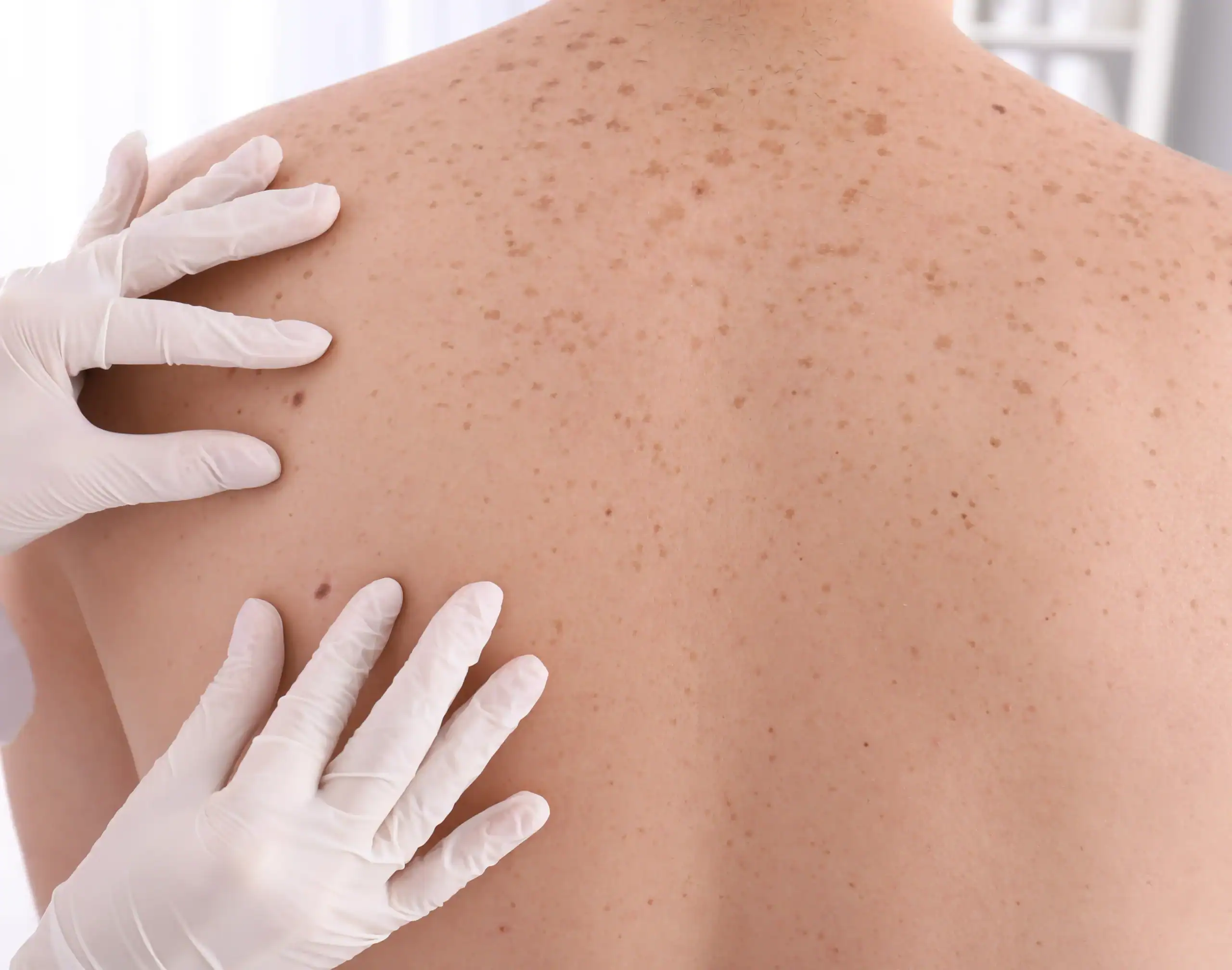 Younger man getting a skin check at dermatologist